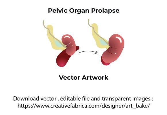 Pelvic Organ Prolapse Vector Graphics and Icons Review